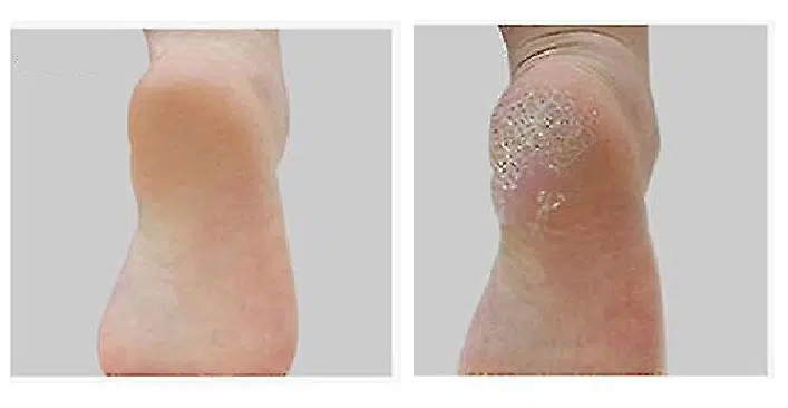 Naturéa FootCare - Baume pieds secs - Talons fendillés - 45gr